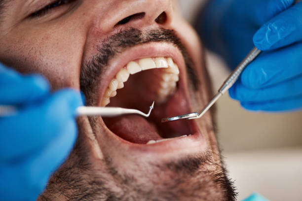 Best Emergency Dentist for Lost Fillings or Crowns in Soledad, CA